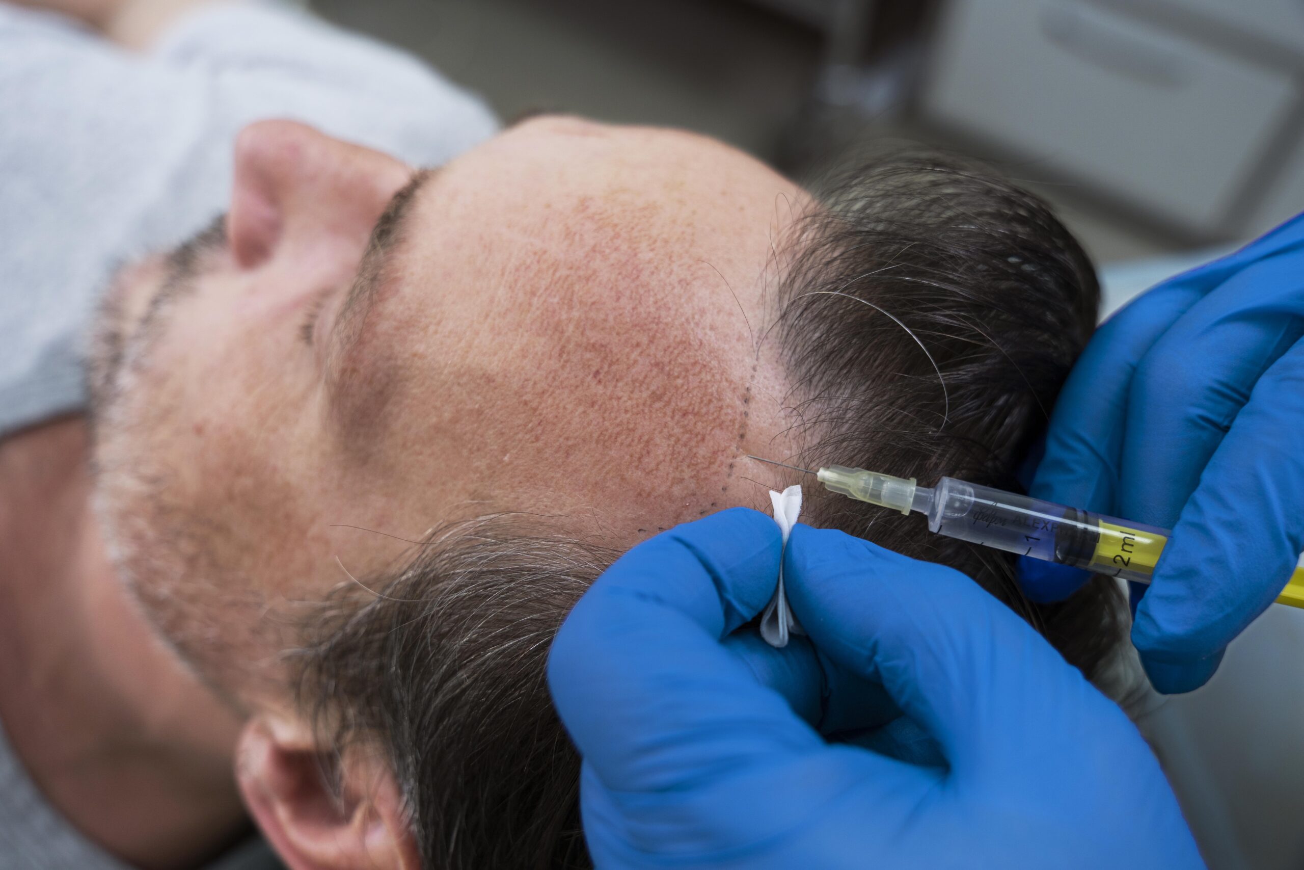 Hypertrichosis